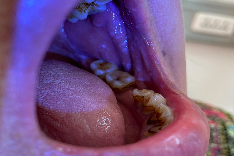 颊黏膜癌溃烂图