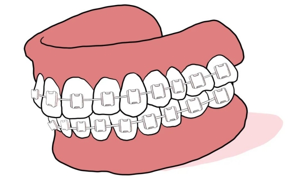 如皋固德口腔医院牙齿矫正多少钱?金属托槽6990起,隐形矫正19800起