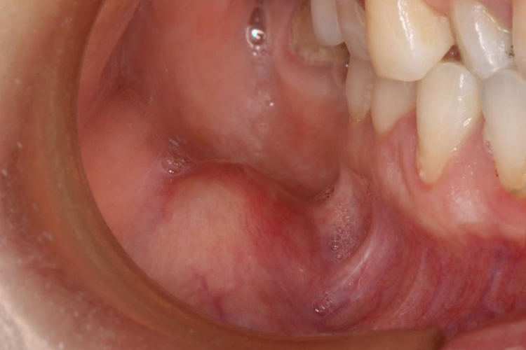 颊黏膜癌增生图