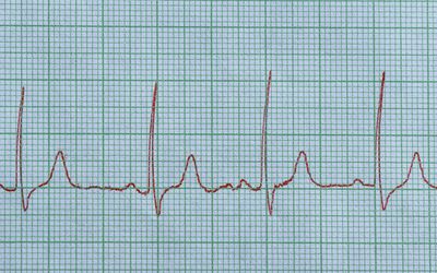 normal sinus rhythm