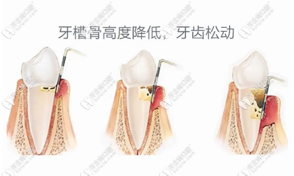 牙槽骨吸收的诊断标准