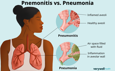 Pneumonitis vs. Pneumonia